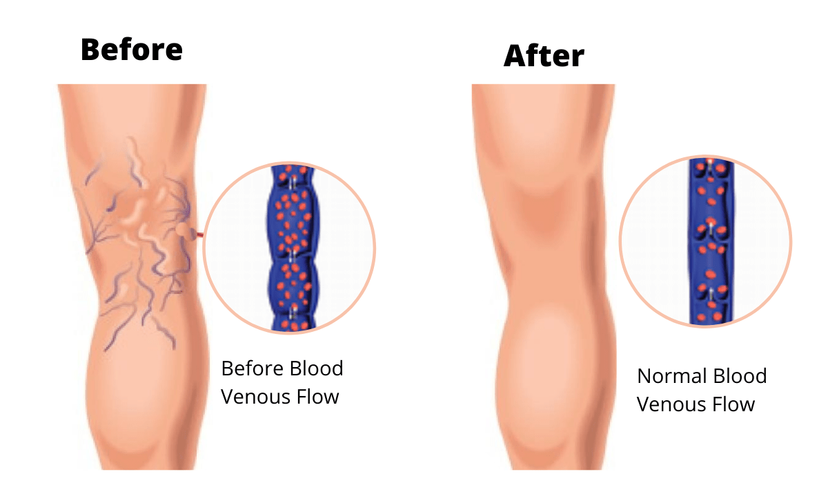 How to Prevent Recurring Varicose Veins